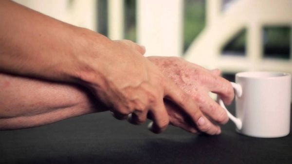 Cali es sede de la primera investigaci&oacute;n del Parkinson en Colombia