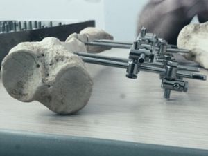 Fijador para fracturas consigue patente en Estados Unidos