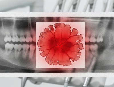 Claves para la detecci&oacute;n oportuna de c&aacute;ncer oral