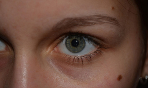 Chequeos de lunares gratuitos en Cali